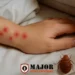 Bed Spider Bites